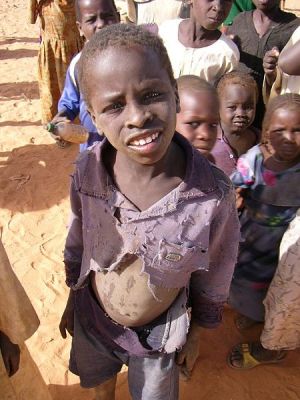 malnourished child
